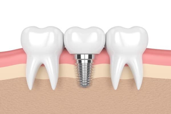 services.implantology.title