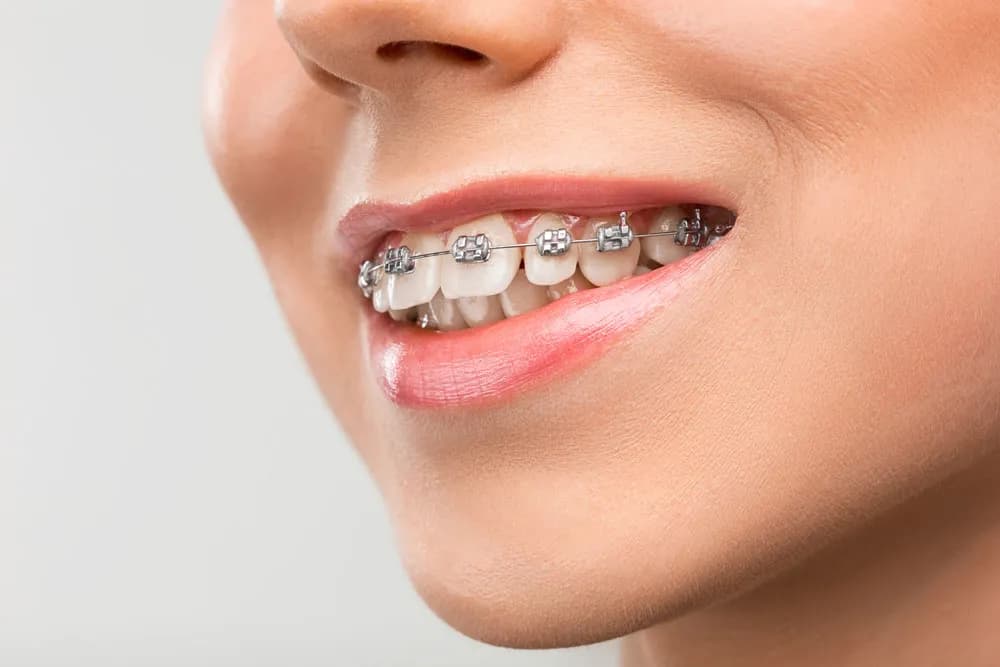 services.orthodontics.title