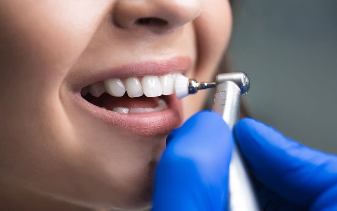 Professional Teeth Cleaning